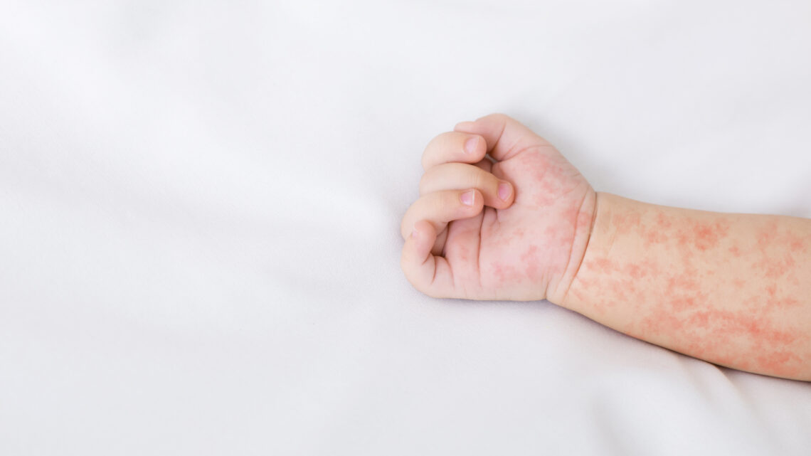 Bostonka u dzieci – zrozumienie i walka z chorobą Bostonka u dzieci – zrozumienie i walka z chorobą